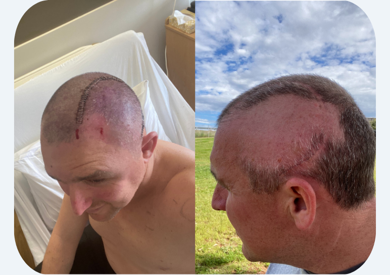 Marcus following his surgery with a shaved head and scaring.